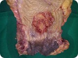 CA Rectum