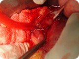 bleeding _duodenal_ulcerb