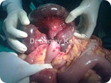 gangrene due to adhesionsg