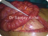 intestinal stricturej