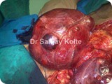 multinodular goitre thyroid 2n