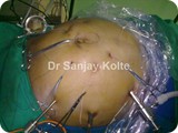 lap repair of rec umbilical herniam