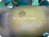 umbilical herniaag