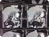 liver abscess lapl