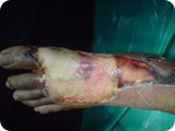 cellulitis gangrened