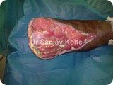 diabetic foot 1j