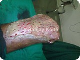 diabetic foot 3l