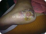 diabetic foot ulcerm
