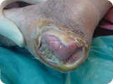 large ulceru